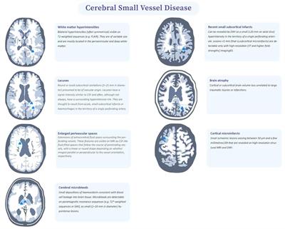 Clinical, Radiological and Pathological Characteristics Between Cerebral Small Vessel Disease and Multiple Sclerosis: A Review